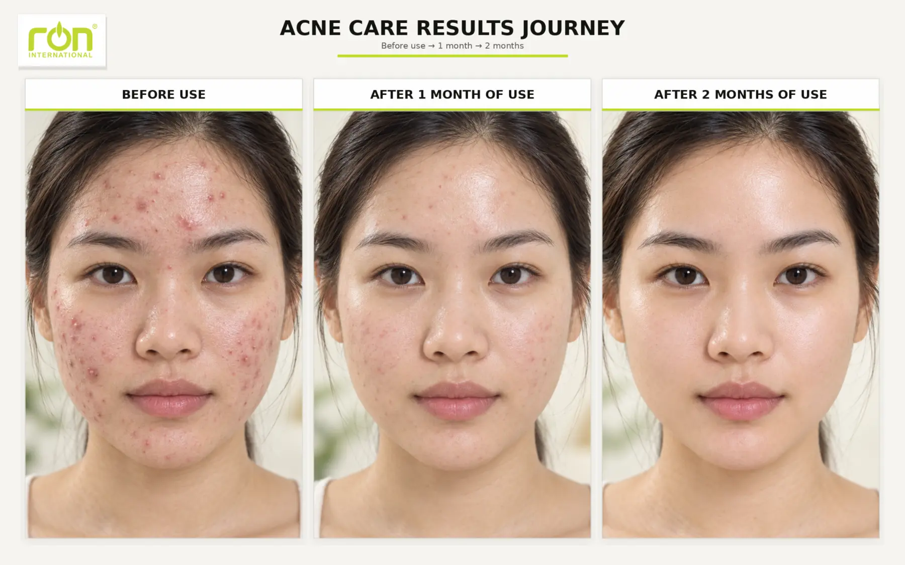 Ilustração de três etapas na jornada de cuidados com a pele propensa à acne.