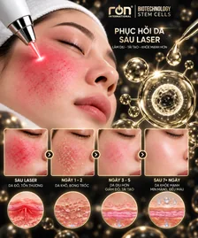 Hình minh họa chăm sóc da sau laser do RON cung cấp; không phải cam kết thời gian phục hồi