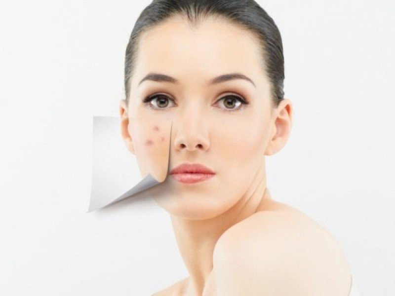 cách trị mụn đầu trắng