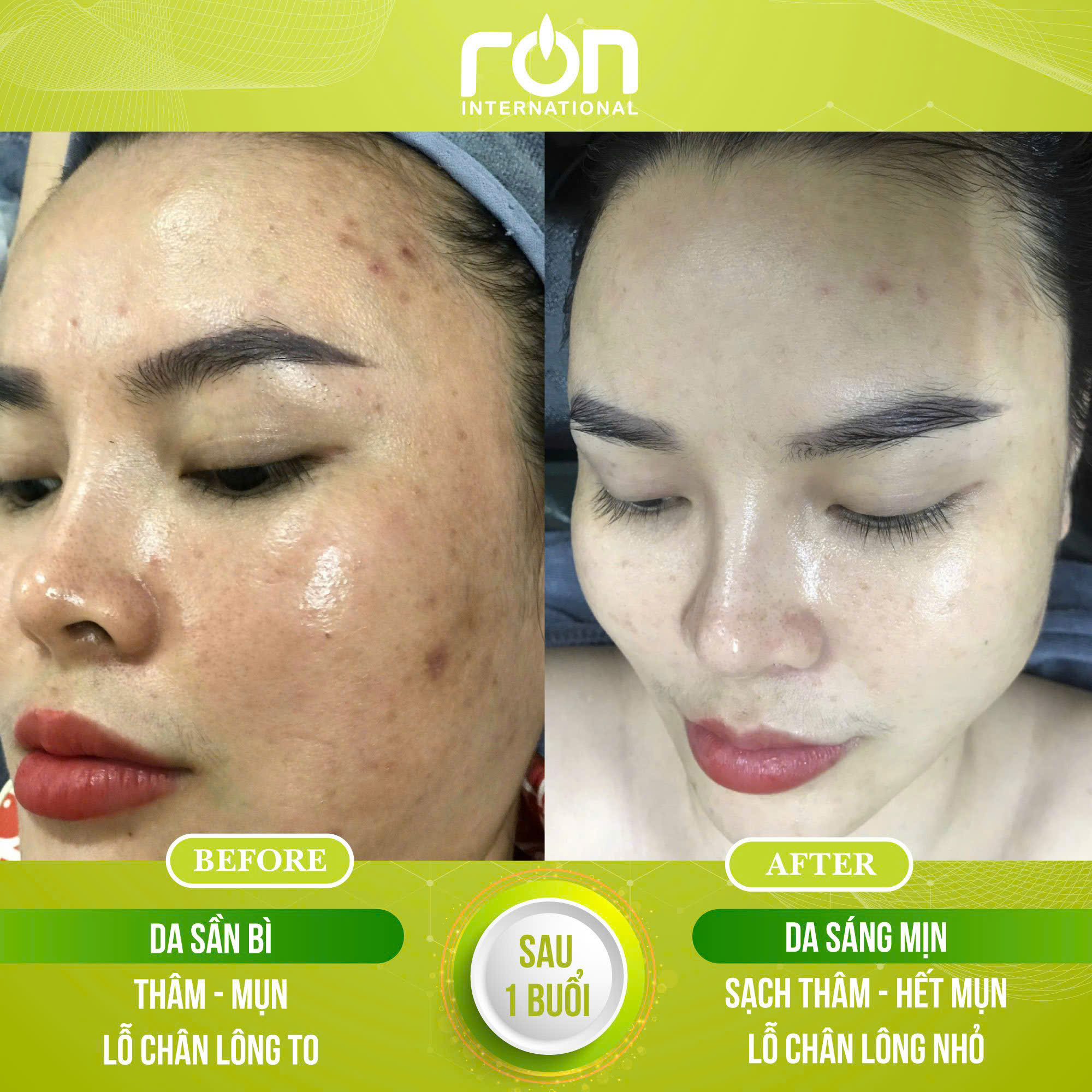 feedback-khach-hang-serum-tri-mun-1