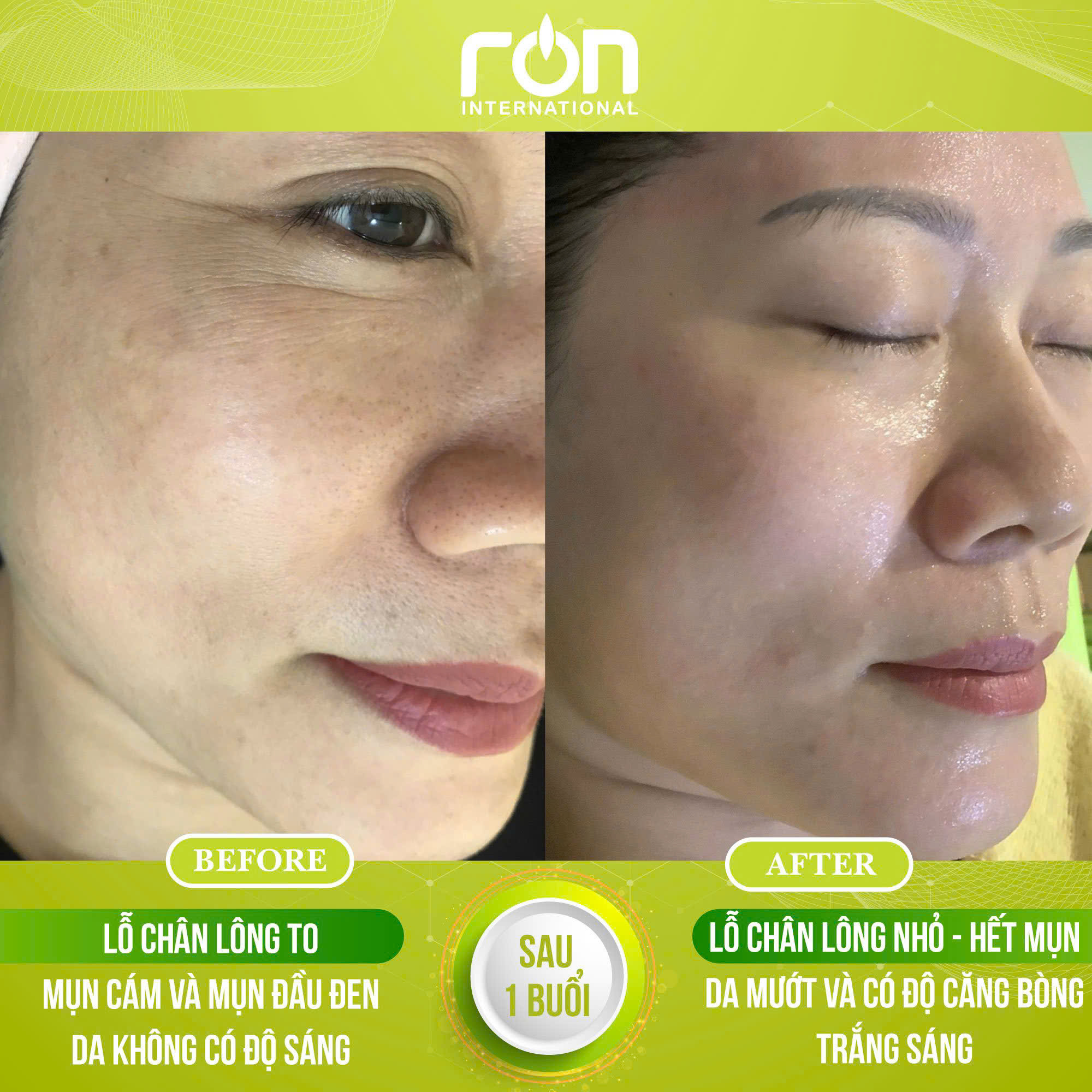 hinh-anh-truoc-sau-mun-spa-3