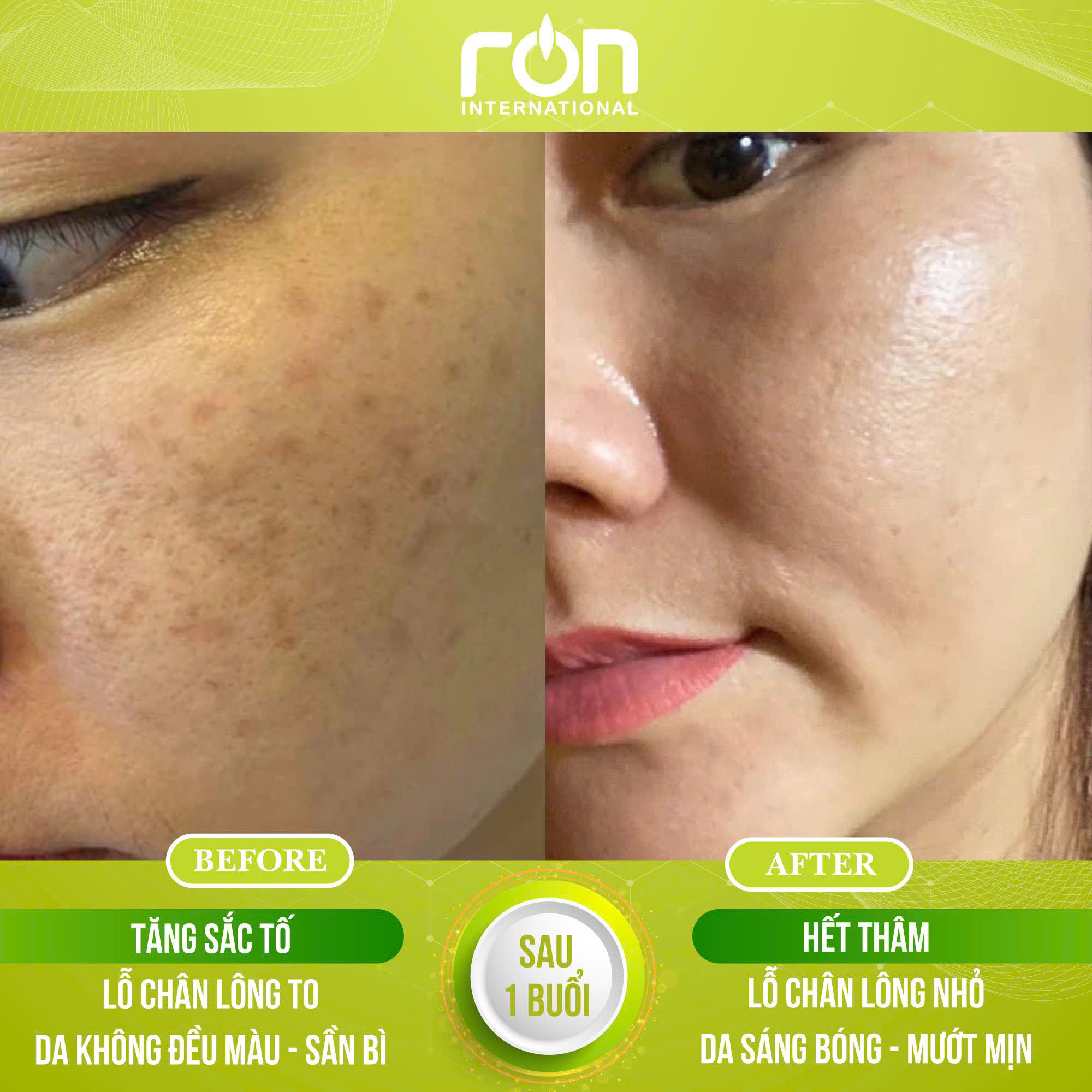 review-san-pham-tri-mun-spa-2