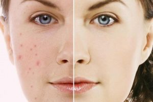 Tế bào gốc trị thâm