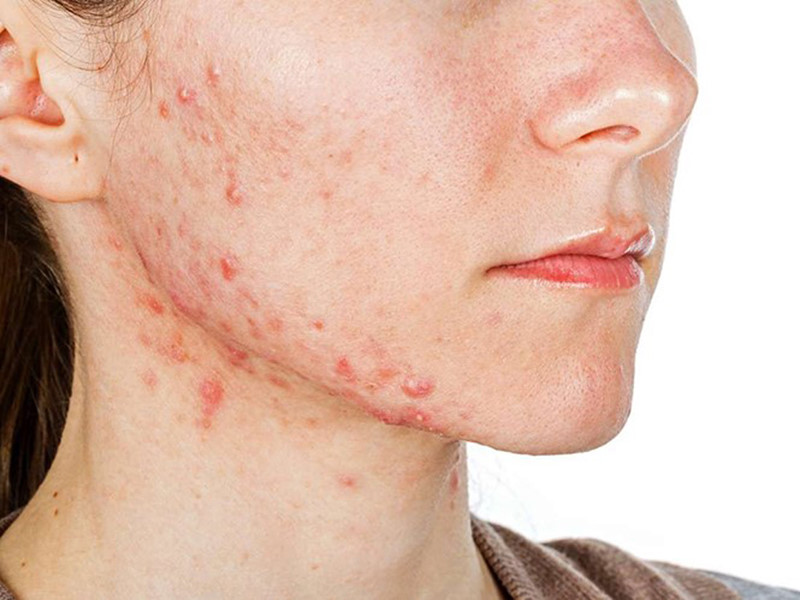 tế bào gốc đặc trị sẹo rỗ