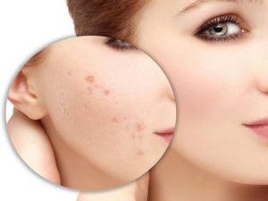 tế bào gốc trị sẹo rỗ