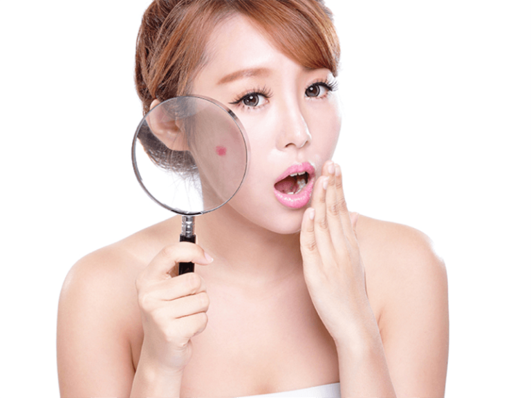 Quan sát vùng da có mụn qua hình minh họa.