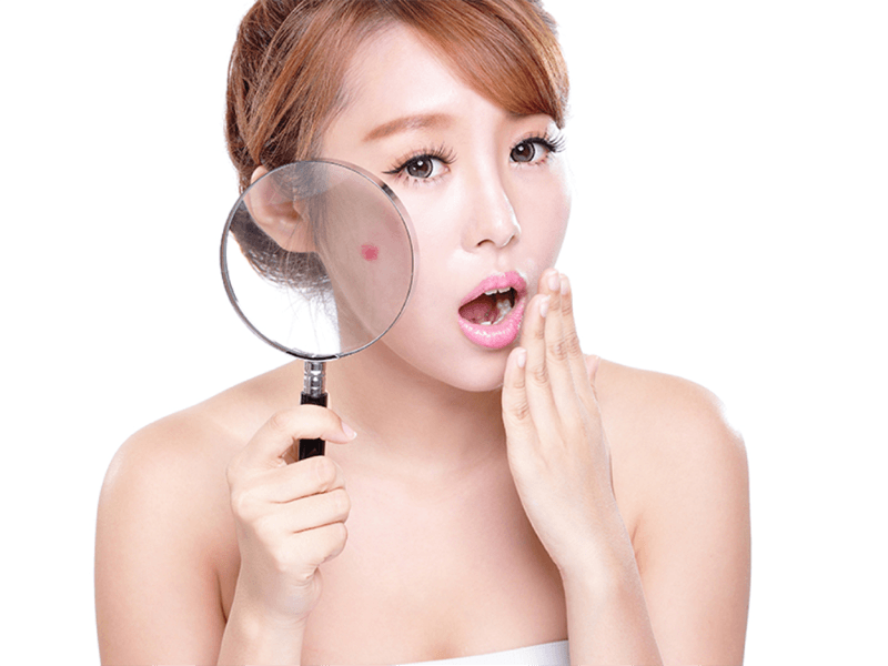 mụn trứng cá