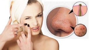 Mụn đầu đen thường xuất hiện nhiều ở phái nữ