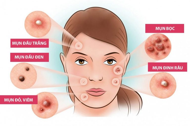 Sơ đồ minh họa các dạng mụn; không phải kết quả của sản phẩm.