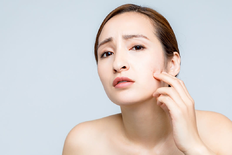 cách điều trị mụn trứng cá