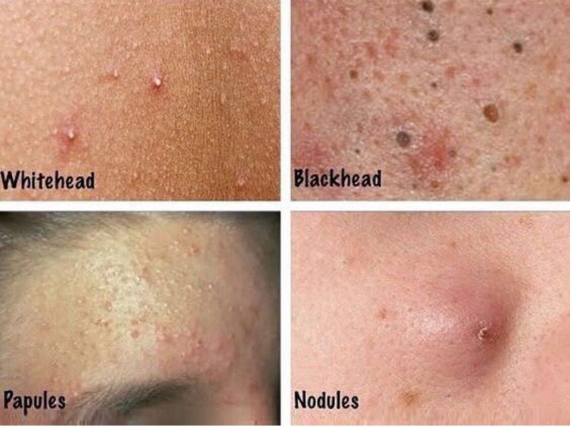 các loại mụn trứng cá