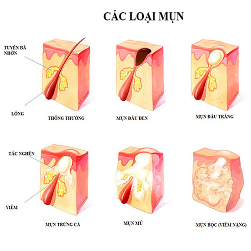 nguyên nhân gây ra mụn