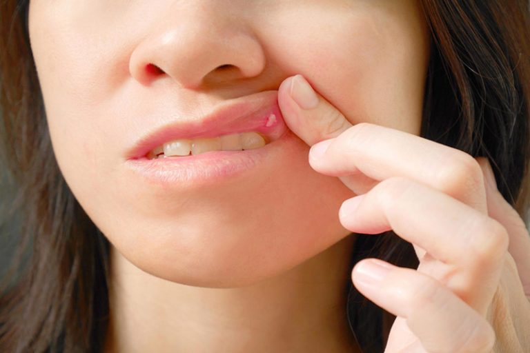 Hình minh họa vùng niêm mạc miệng; không dùng để tự chẩn đoán.